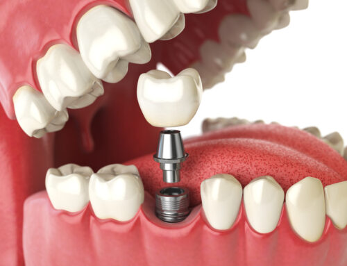 Revolutionizing Tooth Replacement: Dental Implant Options