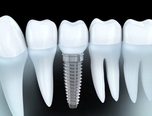 Dental Implants: Cavity-Free Smile Restoration Option